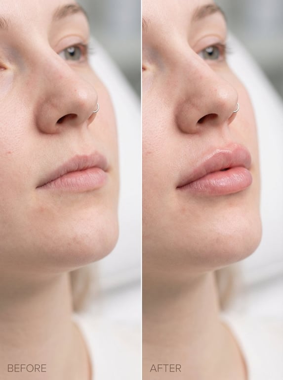 Photorealistic Lip Filler Comparison Macro Shot